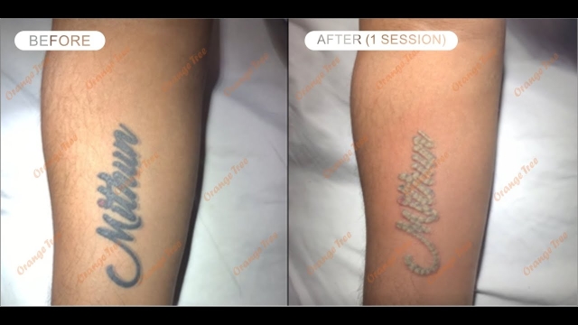 Tattoo Removal Costs – Finding An Inexpensive Way Remove Your Tattoo