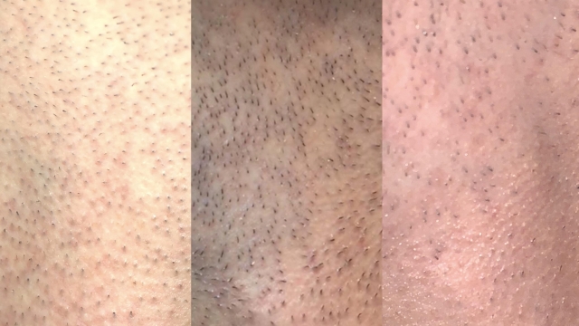 Beating the Burn: Unlocking the Magic of Laser Hair Removal